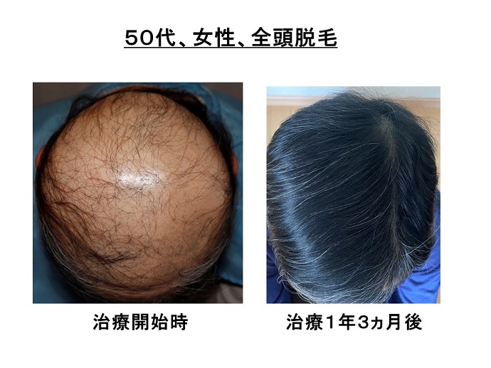 円形脱毛症　病院